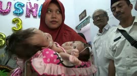kondisi bayi kembar siam yang tidak bisa di pisahkan  masih membutuhkan oksigen  untuk membantu pernapasan