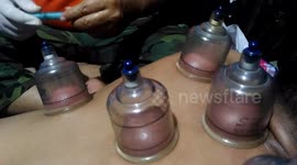 this is how to treat cupping.