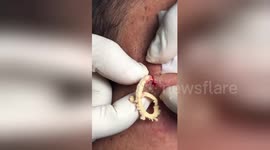 Disgusting moment sub-dermal zit is sliced open and squeezed