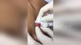 Newsflare Edit - The giant pimple is located on the ear