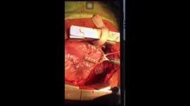 Indian doctors remove large metal fragment from beating heart in high-risk surgery