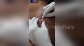 Watch this dermatologist remove a 10-year-old pimple from a man's back