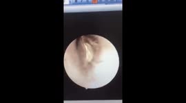The cockroach enters and attacks the patient's ear to nest