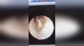 Disgusting moment cockroach crawls out of woman's ear