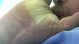 Man's hand inflates like a balloon after allergic reaction