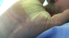 Man's hand inflates like a balloon after allergic reaction