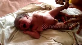 Villagers amazed after baby in India born with four legs