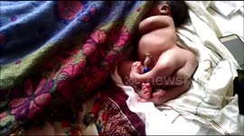 Villagers amazed after baby in India born with four legs