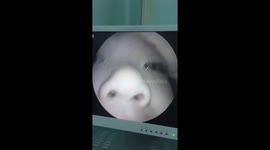 Plastic cords trapped in the nose of 2-year-old girl