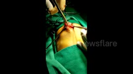 Indian doctors remove massive one kilo hairball from six-year-old's stomach
