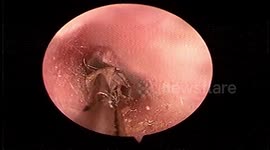 Emergency procedure carried out to remove live moth from man's ear