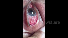 Stomach-churning moment doctor removes 15cm-long parasitic worm from man's eye