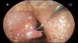 This man had a giant pimple buried deep in his ear canal