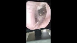 Hundreds of Fungus grow in the patient's ear canal
