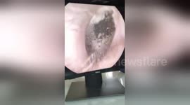 Newsflare Edit - Hundreds of Fungus grow in the patient's ear canal