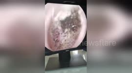 Man has hundreds of ‘mushrooms’ growing inside his ear