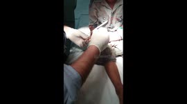 Using Delay Spray, my kid easily go through minor surgery without any pain
