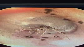 Getting an earful: Cricket found living inside man's ear canal