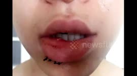 Woman wins £4,500 compensation after IKEA cup exploded in her face