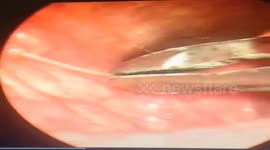 Doctor removes 4cm fishbone stuck in man's throat