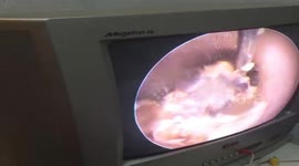 Doctor removes 15 years' worth of gunk from woman's clogged ear