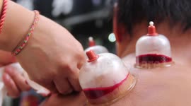 Cupping therapy on the streets in China