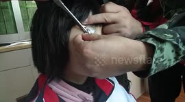 Chinese girl gets eyelid stuck in zipper while putting on school uniform