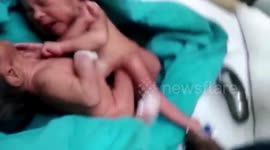 Moment surgeons took a celebratory selfie - after successfully separating three-day-old conjoined twins in a painstaking operation