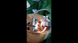 Doctors conducts surgery to pick up a leech has lived in the patient's jaw sinuses for 3 months