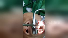 Sickening moment wriggling leech is removed after living inside woman’s throat for THREE MONTHS
