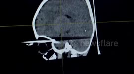 Knitting needle impales into boy's eye