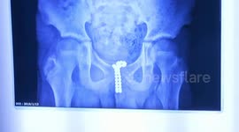 Doctor removes dozens of magnet balls from teenage boy's urethra