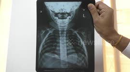 Indian doctors remove lollipop plastic stick from baby's stomach