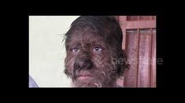 Watch-Longer vesion -The 13 year old wolf boy” having long hair on face in Ratlam in india