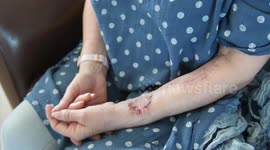 Grandmother gets new tongue fashioned from arm flesh after cancer treatment