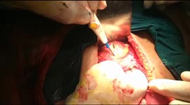 Graphic: Doctors in India remove 3.5ft-long thread from teen's intestines