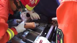 云南建水  建水一小孩将手伸进绞肉机被卡 被救出后医护人员建议做截肢处理
