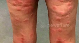 A mum was left with painful burn-like rashes all over her body after a serious allergic reaction to VAPING for the first time