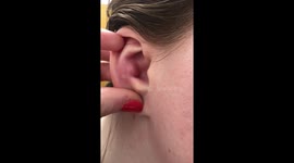 Explosive cyst pop on ear