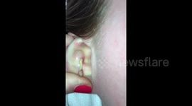 No a-CYST-ance needed for US woman while she drains her abscessed ear