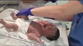 C section delivery for new born baby