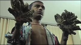 Bangladesh man suffering from rare tree man syndrome undergoes 24 surgeries