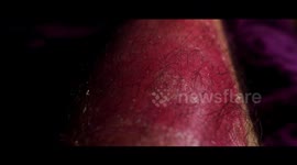 A man with a debilitating condition can barely walk or wear clothes and has even gone temporarily blind because he sheds six months of skin - a WEEK