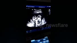 Identical twin sisters spotted 'fighting' in womb during ultrasound in China