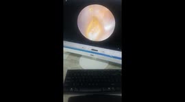 The doctor removes the plastic bead from the 5-year-old boy's ear