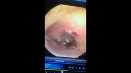 Skin-crawling moment cockroach burrows inside man's ear during removal in Vietnam