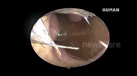 Sickening moment writhing 10cm-long leech is removed from woman’s nostril