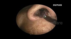 Woman in Vietnam has blood-sucking leech pulled out her nostril