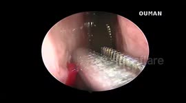 Another close-up video of a writhing, blood-sucking leech being removed from a man's nose in Vietnam