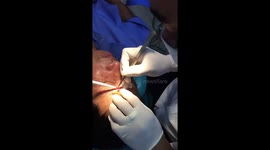 Vietnamese man has 3cm piece of glass removed from his forehead after TWO MONTHS